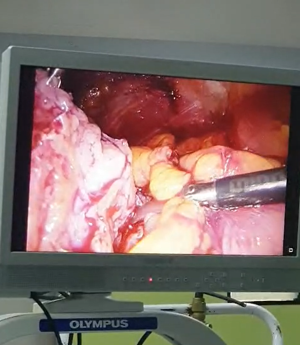 Laparoscopic removal of cancer of kidney by saving kidney